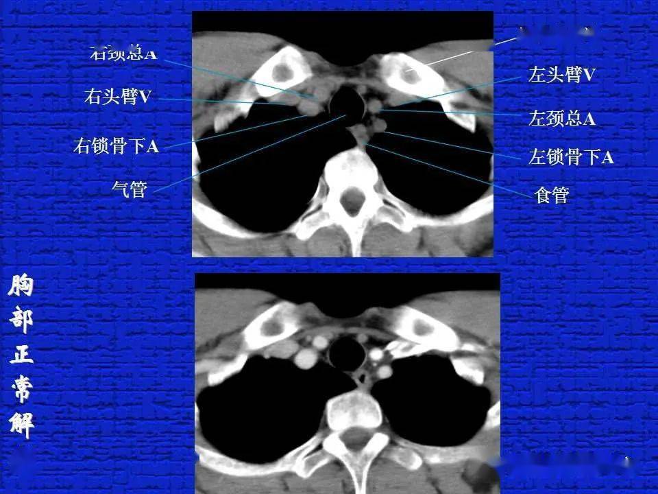结合解剖谈正常胸部CT读片-搜狐大视野-搜狐新闻