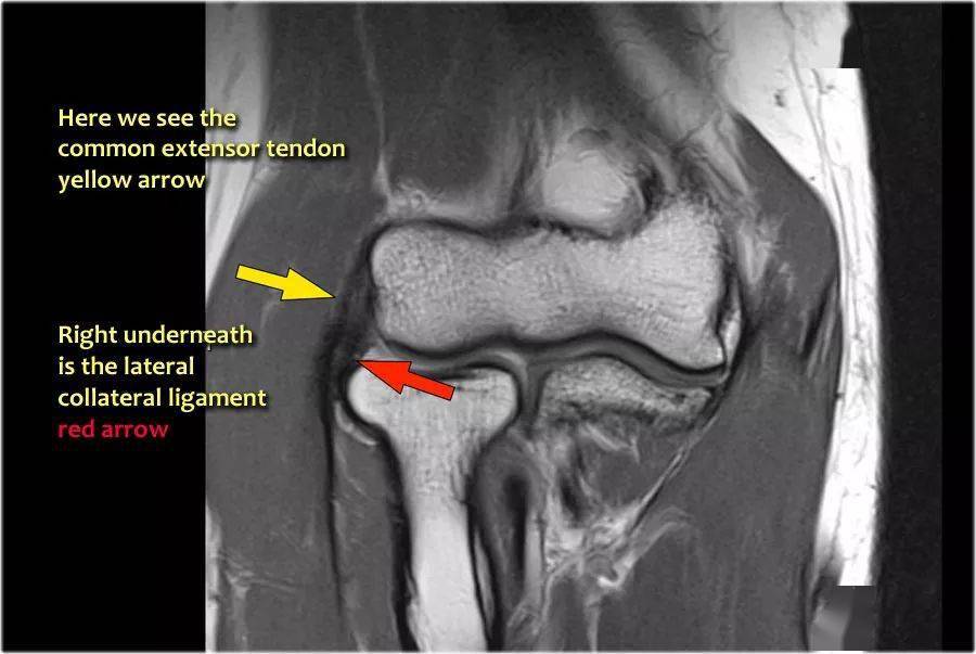 肘关节mr解剖及疾病详解