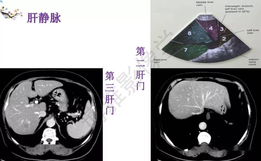 收藏丨肝臟分葉分段的影像解剖