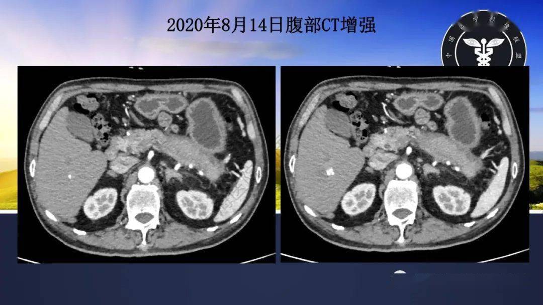 胰腺丨igg4相關性自身免疫性胰腺炎