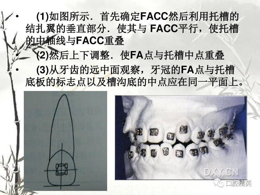 托槽粘接位置