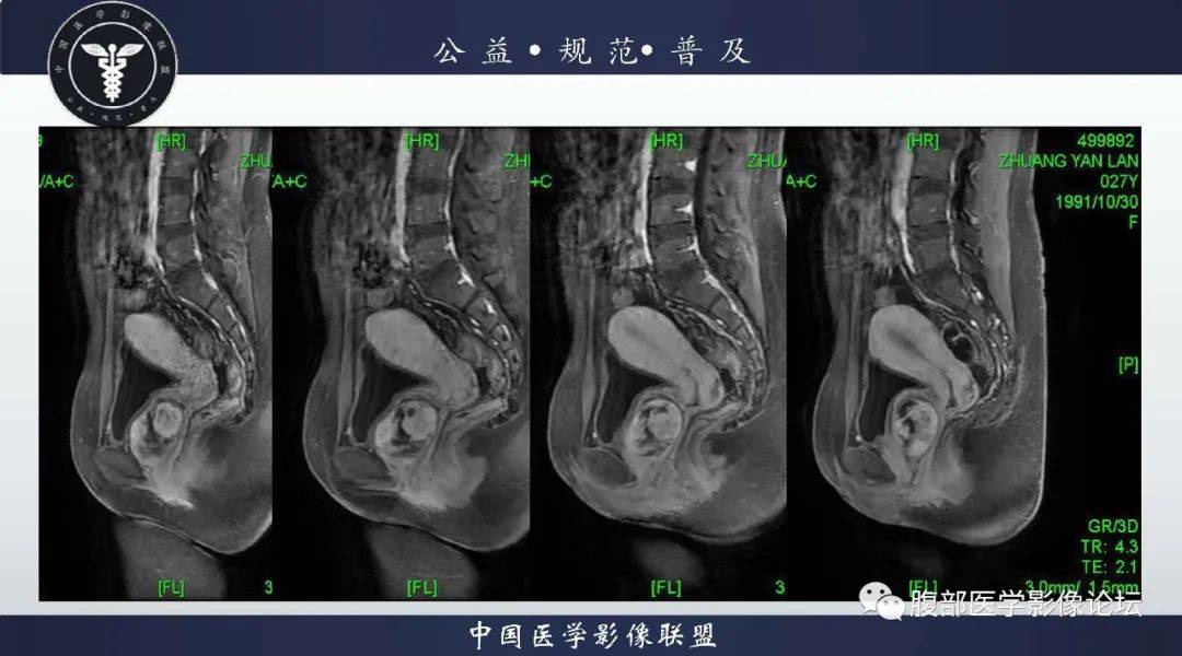 陰道丨血管肌纖維母細胞瘤