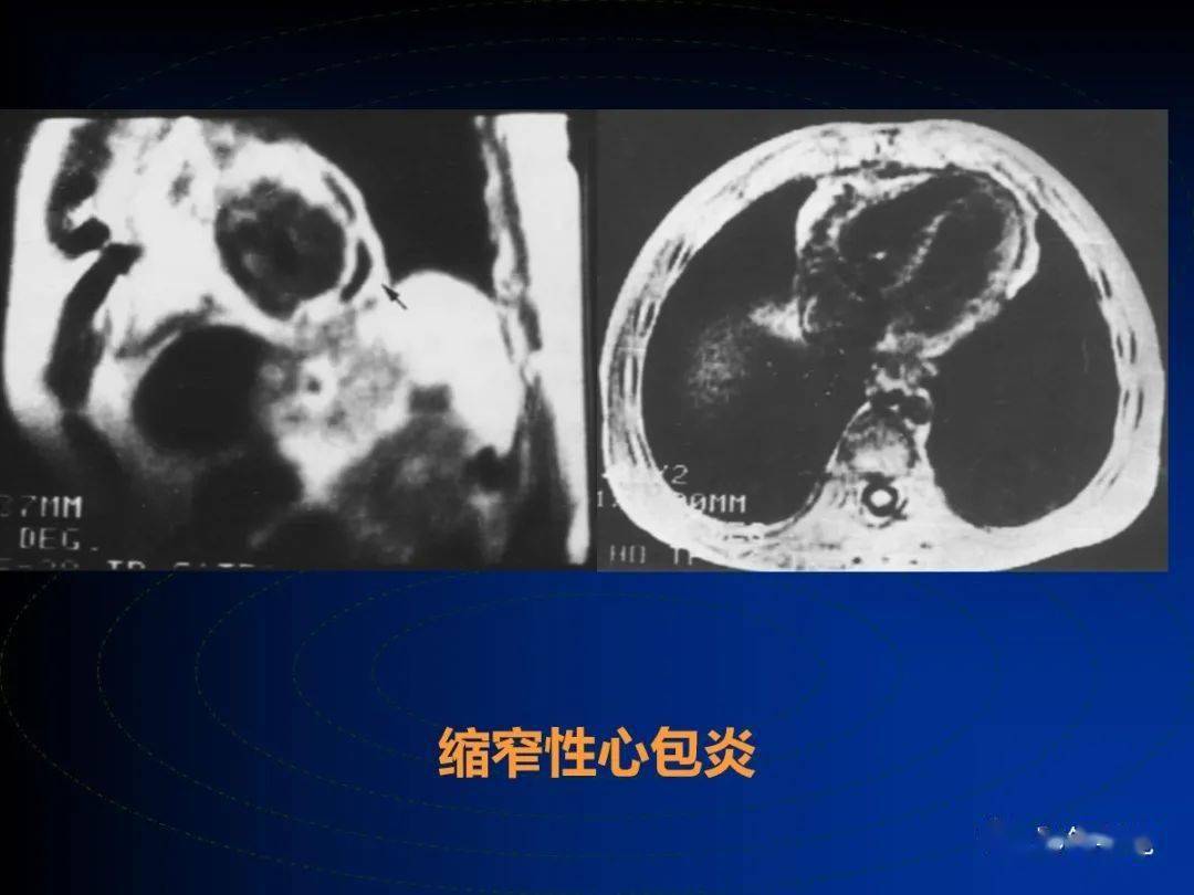 心包疾病的影像学诊断
