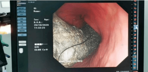 初三女生腹痛难忍原因竟然是爱吃头发