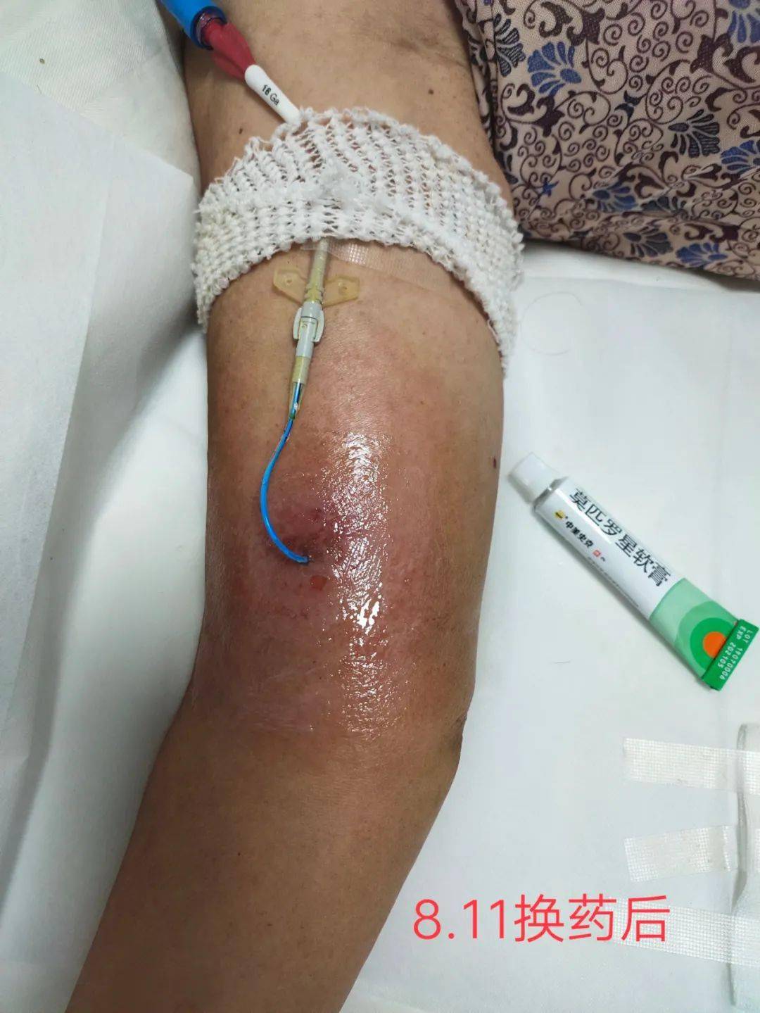 picc导管穿刺部位出现水泡需要拔管吗