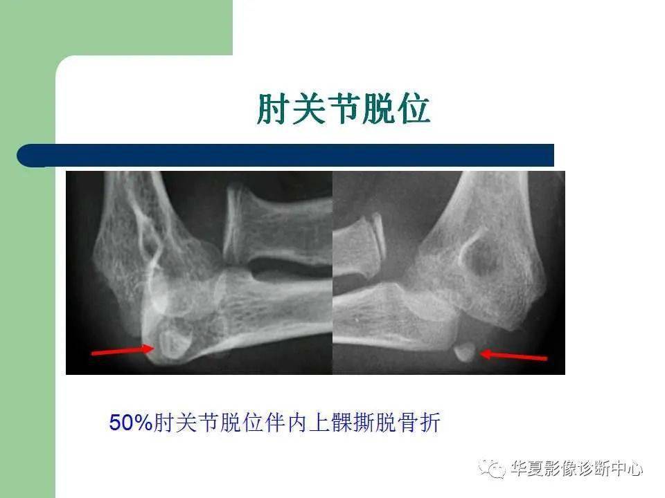 肘关节正常ct解剖图图片