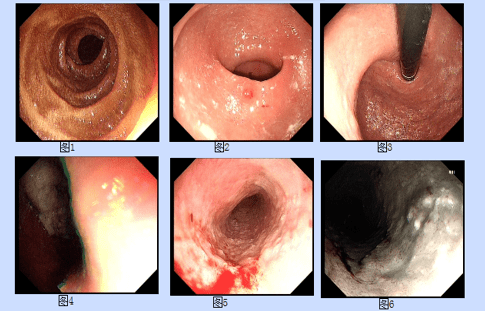 食道鳞癌图片图片