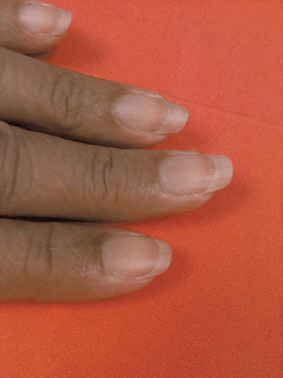 指甲特征与慢性肾脏病