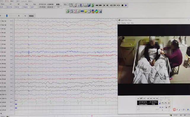 24小时脑电图注意事项图片