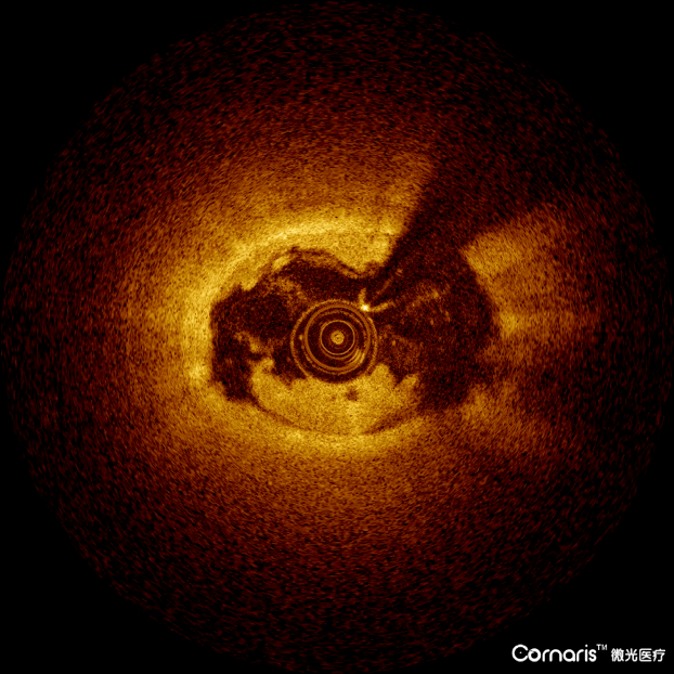 国货之光中科微光医疗oct首批试用特辑