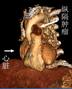 1毫升3釐米20分鐘我院專家用這技術輕鬆為患者切除縱膈腫瘤