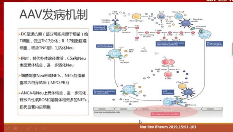 在發病機制方面,首先aav與遺傳因素存在關聯.