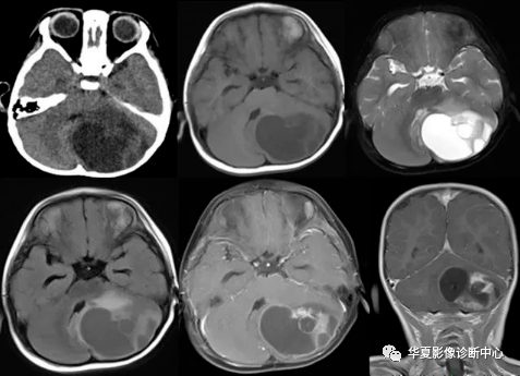 【影像基础】脑内胶质类肿概述_肿瘤