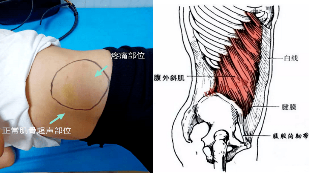 女性左侧腹股沟区疼痛图片