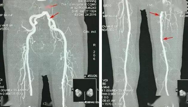 下肢动脉解剖图谱CT图片