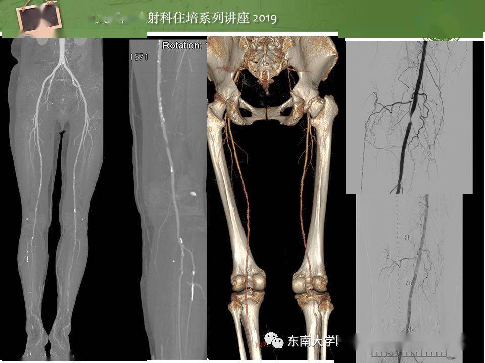 东大影像丨下肢cta的检查流程及评价