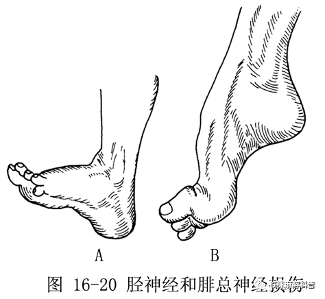 腓总神经走向图图片