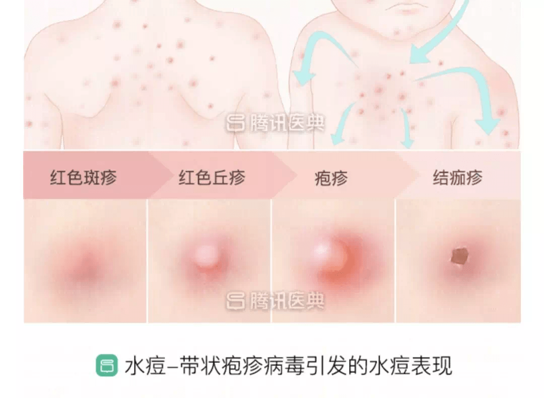 "水痘"和"青春痘"虽然都叫"痘",但此痘非彼痘,二者并没有什么关系.