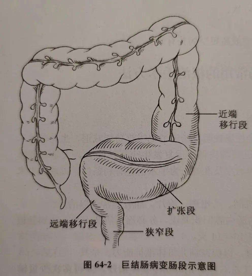 高中女生長期便秘子宮竟被擠到一邊醫生為她灌腸導瀉後輕了8斤