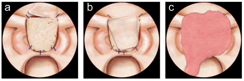 【精选编译】内镜下经鼻采用多层组织和鼻内打结缝合修补硬膜缺损
