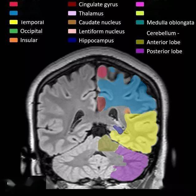 mr入門丨腦葉解剖分佈mri圖像彩色標註