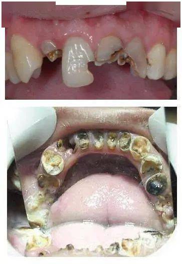 牙齿烂到根本停不下来怎么办