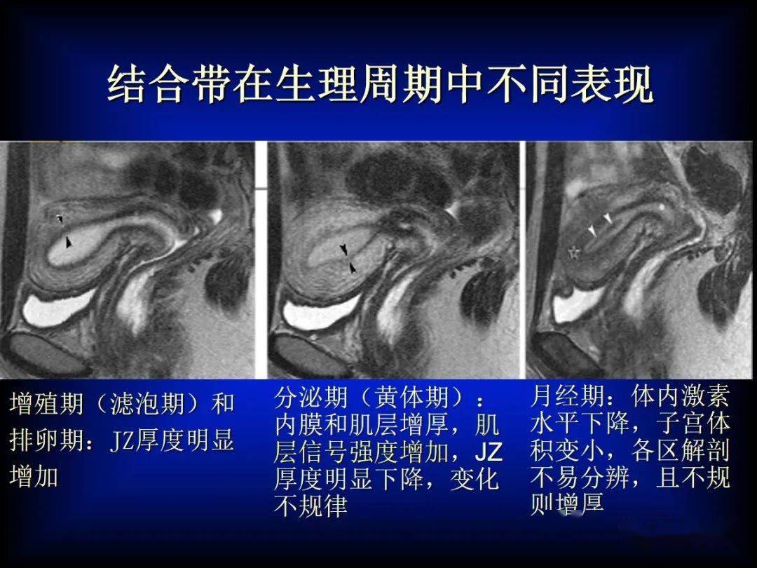 需要借助其他的影像学表现,如(1)在t2wi低信号的子宫肌层内见到局灶性