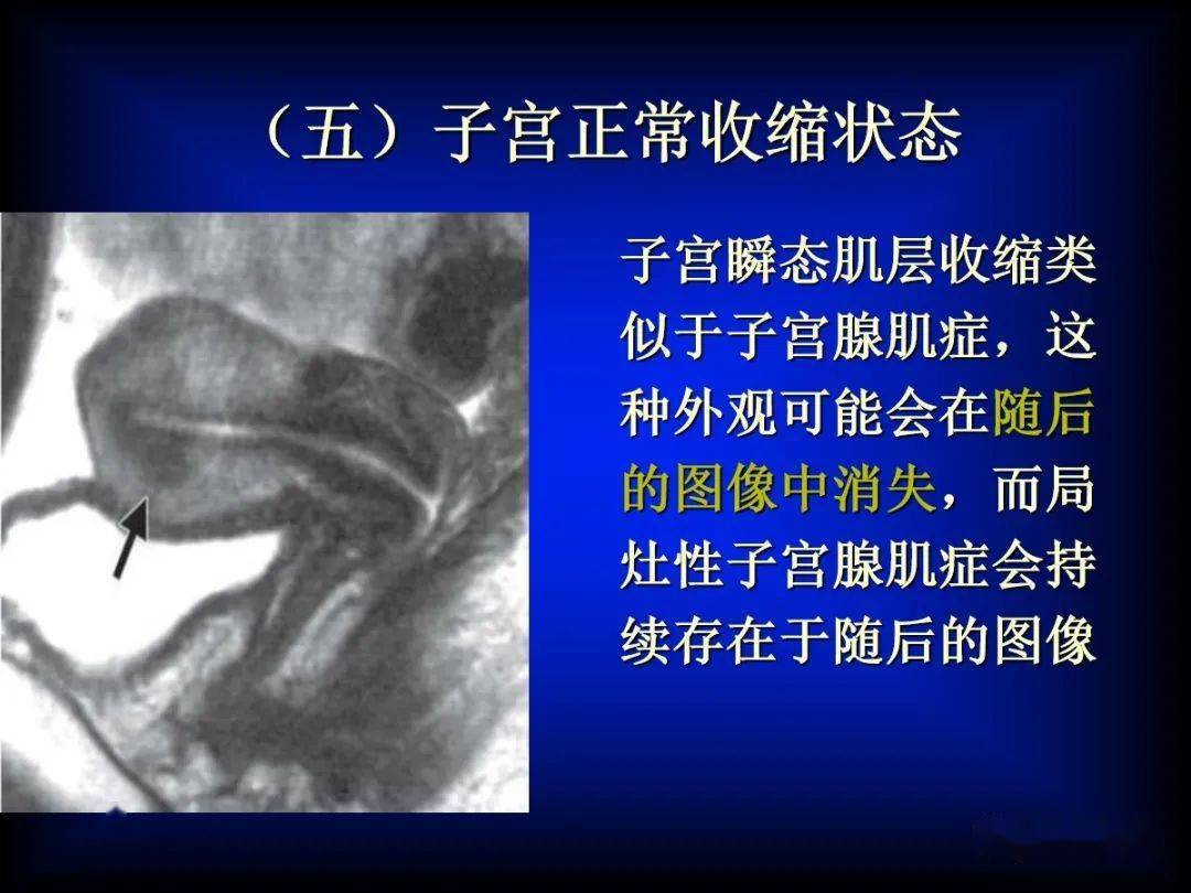 子宫腺肌症的MRI表现_内膜