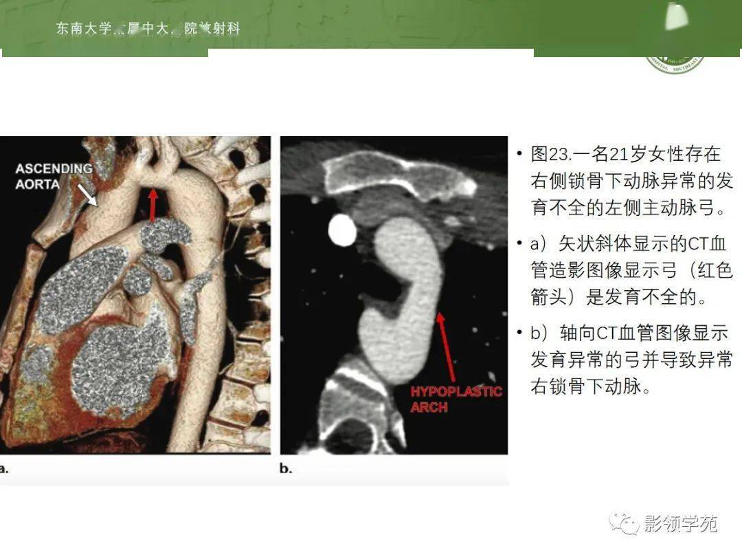主动脉弓先天变异和异常影像表现