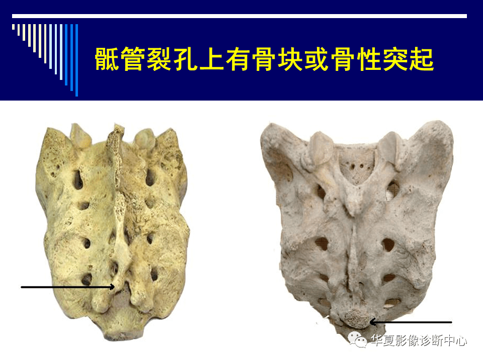 经典课件影像那些需要知道系列骶骨的解剖学变异