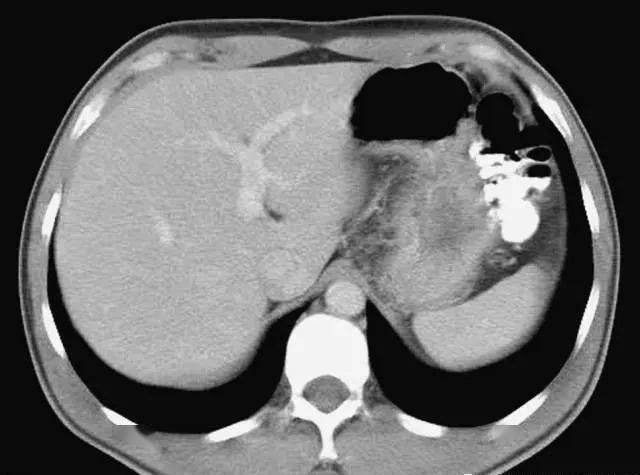 每位影像科医生都应该掌握的腹部ct基础读片36张看完就会了