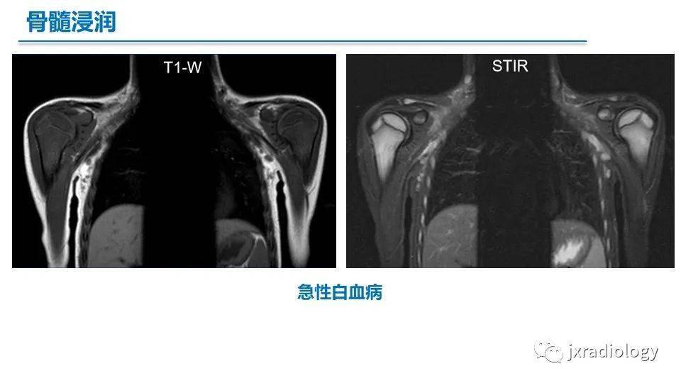 黄骨髓红骨髓图片