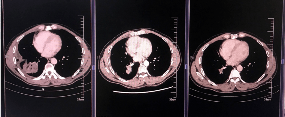 3疗程新辅助治疗后肿瘤明显缩小替雷利珠单抗联合化疗使局部晚期肺