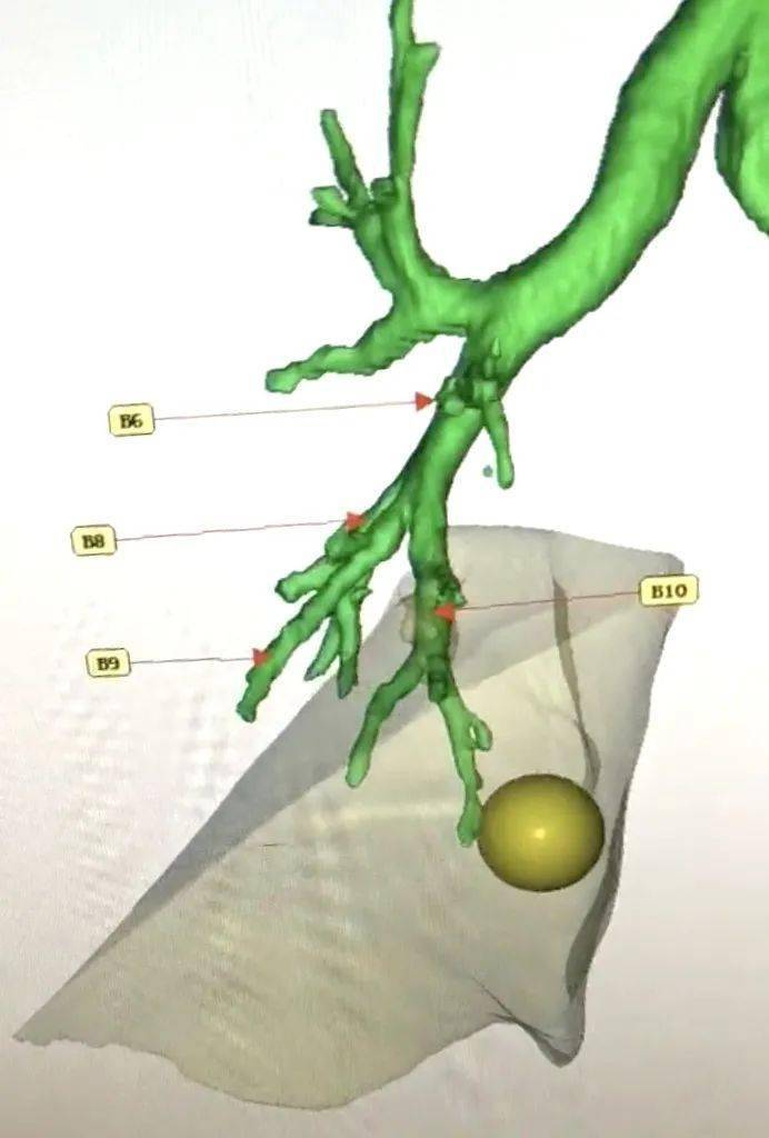 聚焦临床市中心人民医院首例3d重建3d胸腔镜复杂肺段切除术患者顺利