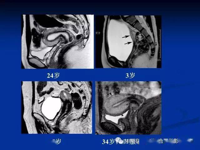 女性生殖系統正常解剖及表現