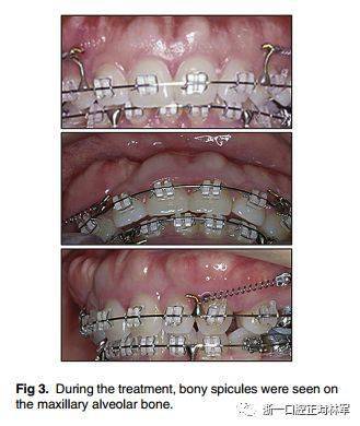 病例分享双牙槽突前突用微螺钉内收前牙一例