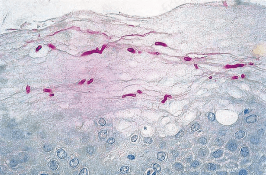 脚气真菌图片 显微镜图片