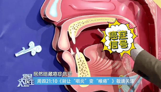 喉癌和咽炎的区别图片图片