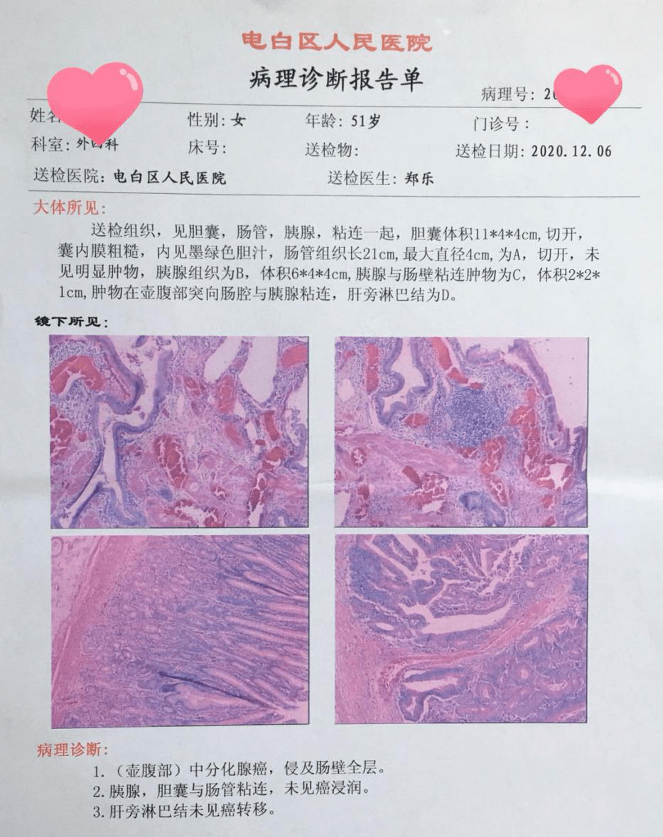 胰腺癌病理报告图片