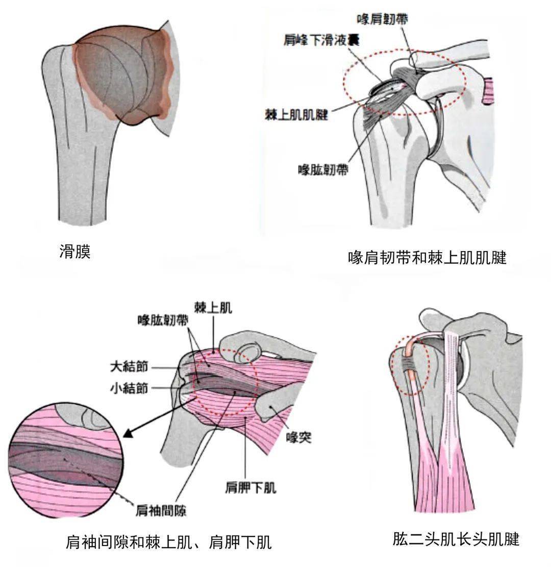出现在关节四周的滑膜炎,一旦扩大至肩峰下滑液囊,旋转肌袖,肩袖间隙