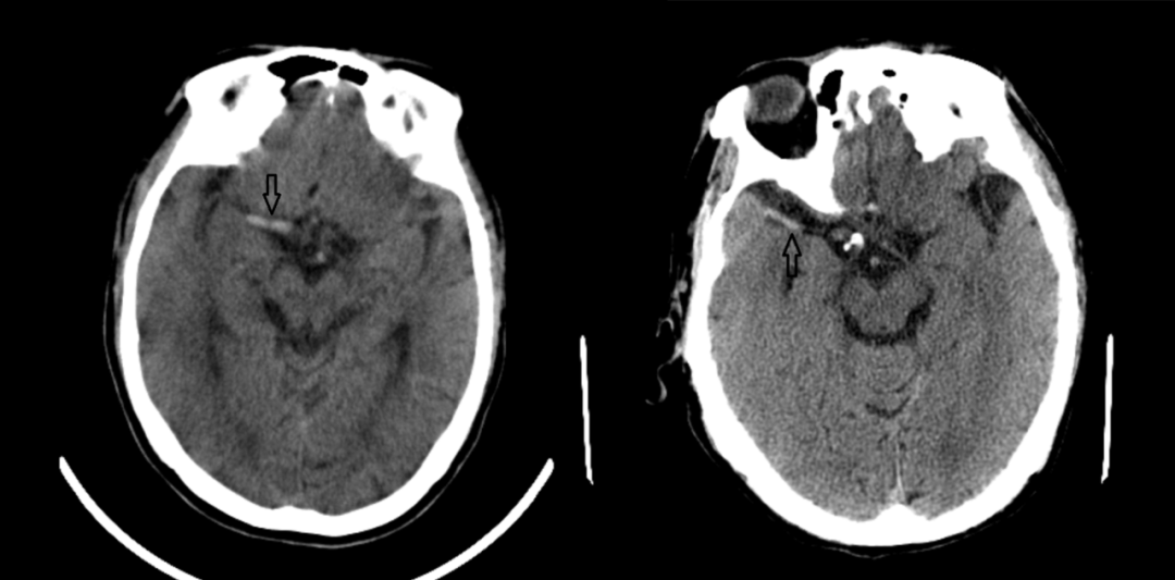 67超急性期大面积脑梗死ct平扫表现