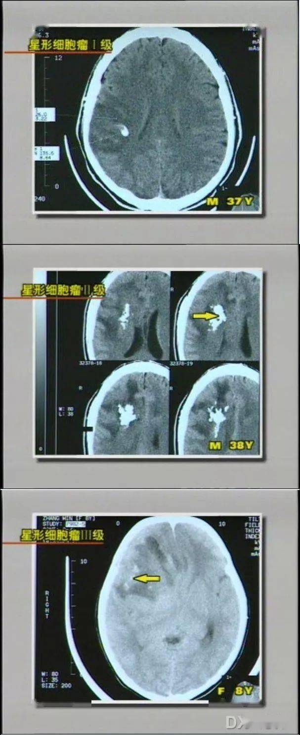 36种颅内钙化你都弄清楚了吗