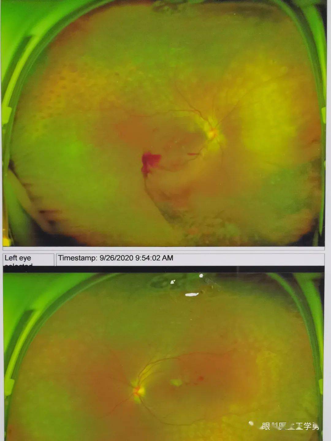 增殖期糖网的视网膜激光治疗图片