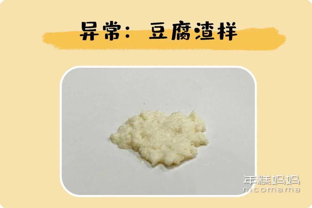 白色豆腐渣状分泌物图片