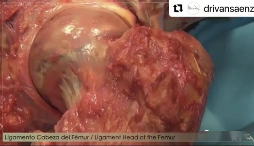 越运动越加重,股骨头坏死原来和人体平衡有关