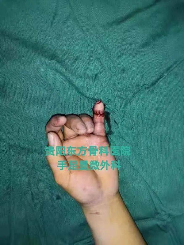 手术室里的绣花活靠手艺救活一个个断指断肢