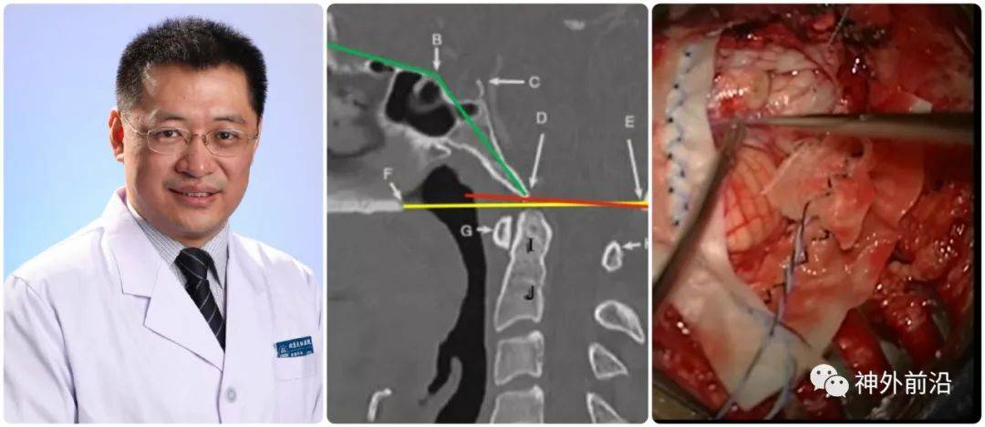 天坛小儿神外专访宫剑儿童chiari畸形的天坛小儿神外诊疗策略上手术指
