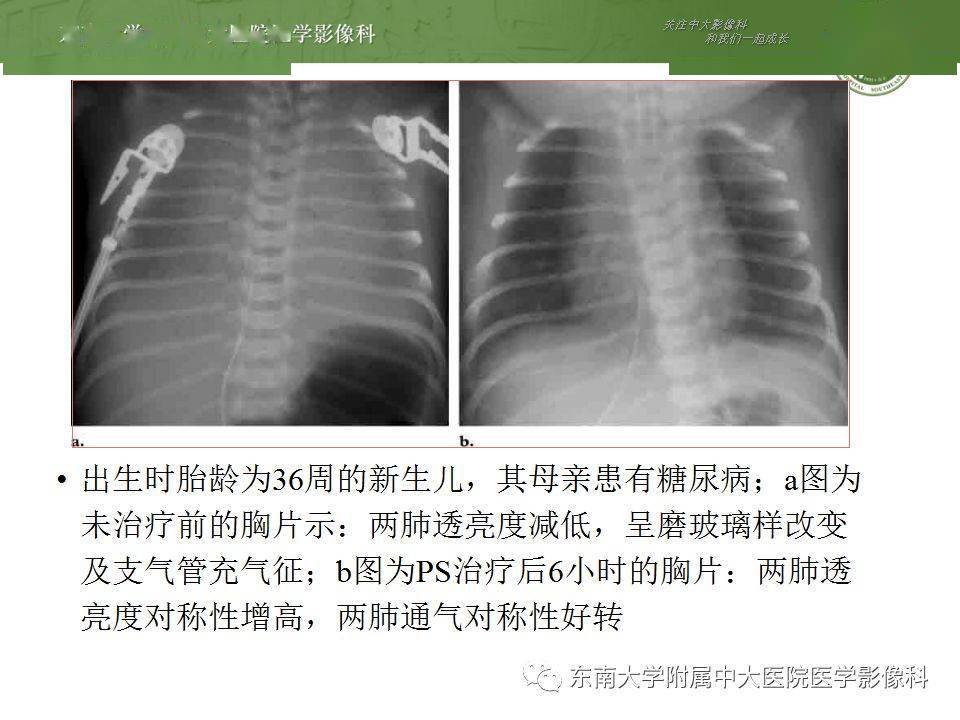 恶化:①间质性肺气肿②支气管肺发育不良③pda:肺充血,心影增大