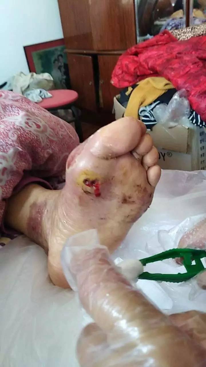 但问题是截肢后的伤口并不会愈合,她女儿的朋友是我们的会员,让她妈妈