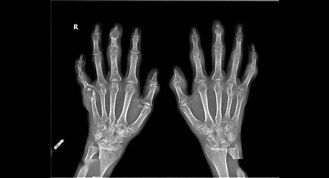 28岁小伙痛风13年关节里竟已长出石头